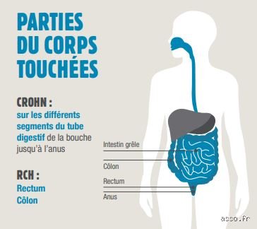 Peut-on guérir d'une maladie inflammatoire de l'intestin ? Ce que la science nous cache encore en 2026