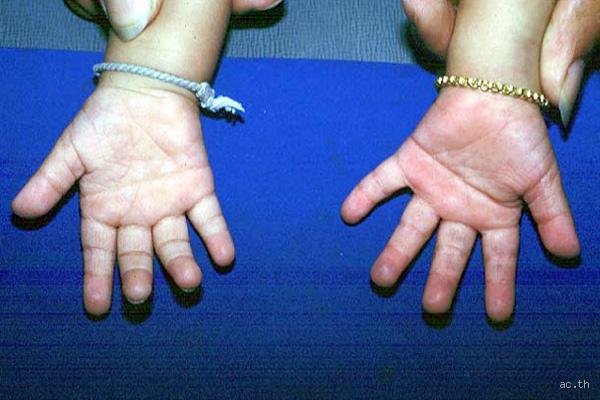 Wie sieht eine Vierfingerfurche aus?