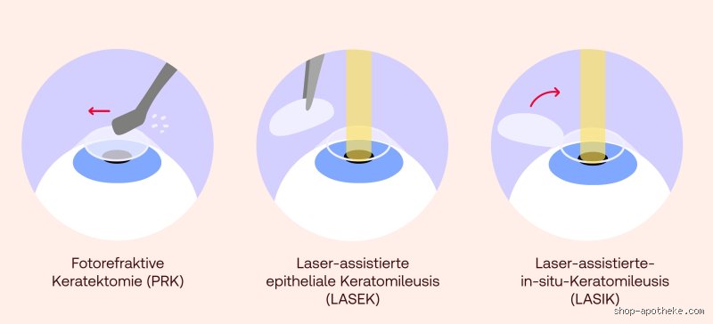 Ist Augen lasern dauerhaft?