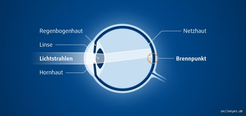 Muss ich meine Hornhautverkrümmung ignorieren? Kann man die Augen Lasern trotz Hornhautverkrümmung?