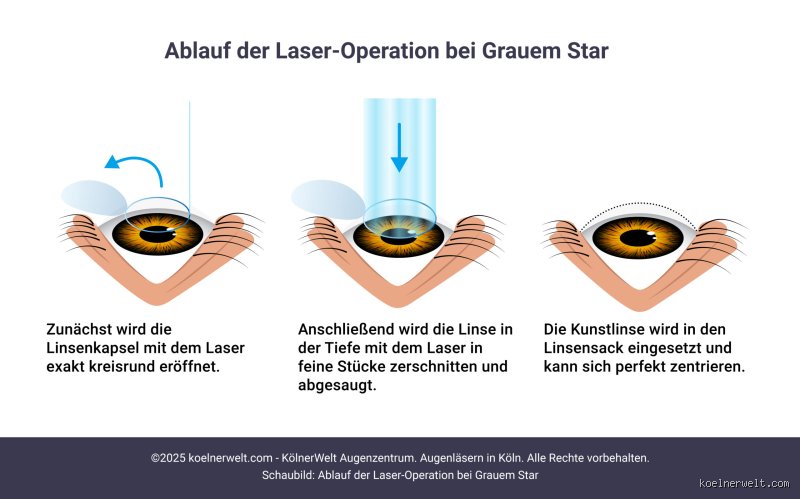 Kann man eine künstliche Augenlinse Lasern? Die nackte Wahrheit über Nachkorrekturen und den Nachstar