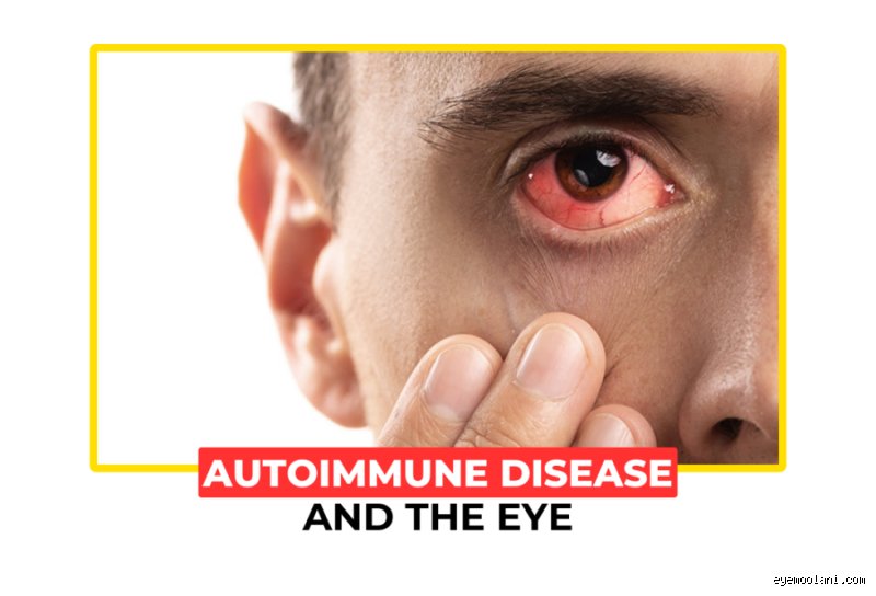 Welche Autoimmunerkrankung greift die Augen an?