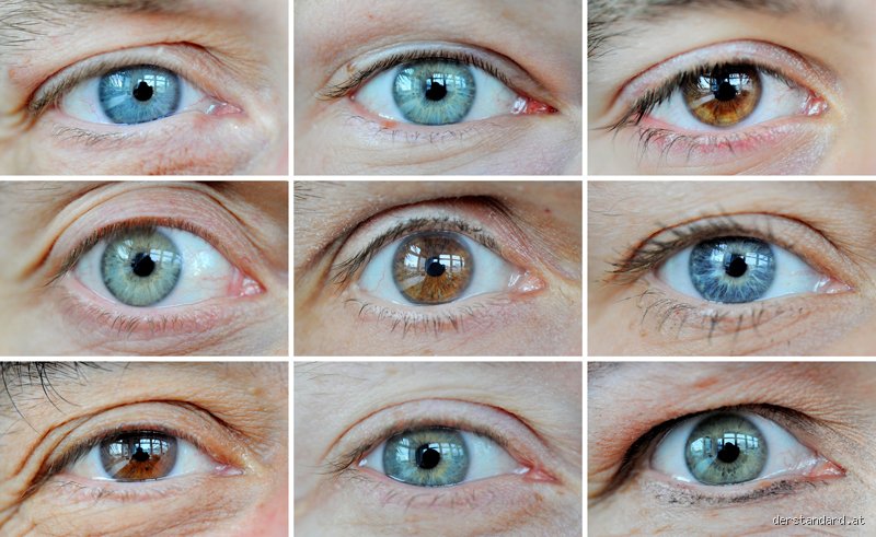 Welche Krankheit verändert die Augenfarbe? Die überraschenden medizinischen Ursachen für einen Farbwechsel der Iris