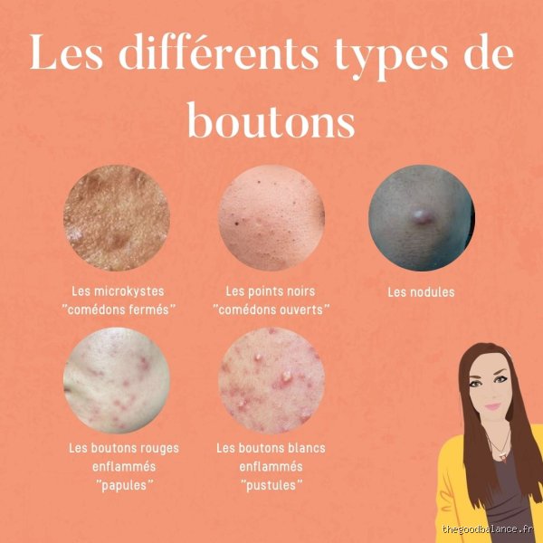 Mais qu'est-ce que c'est, ce truc BLANC qui sort des boutons ?! Horreur et fascination...