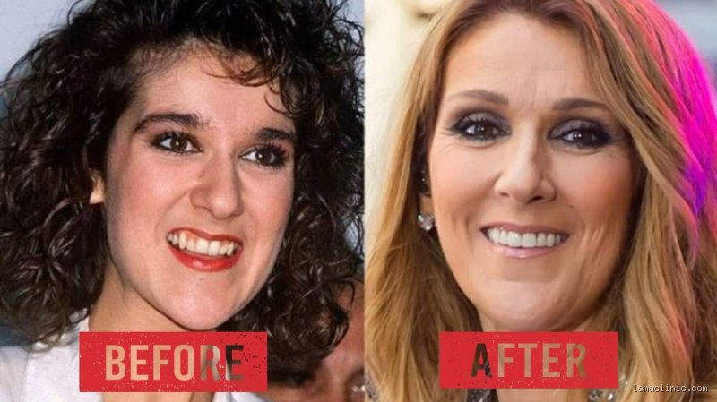 Le sourire de Céline Dion : Does Celine Dion wear dentures ou est-ce le triomphe de la dentisterie esthétique moderne ?