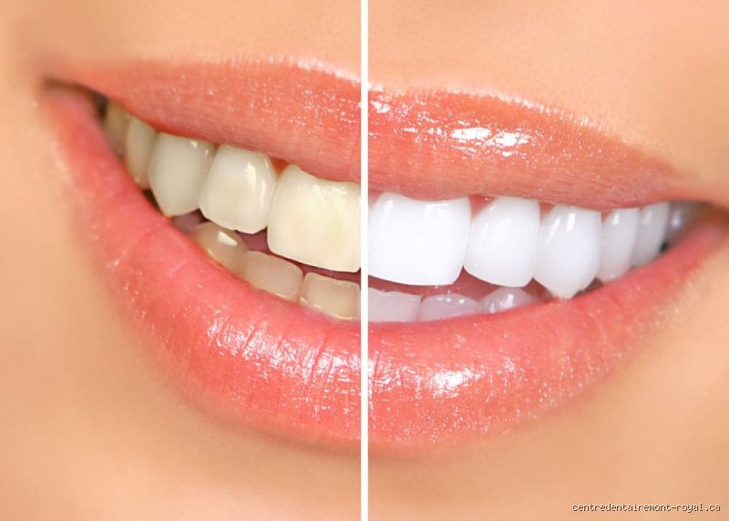 Est-ce bon de blanchir ses dents et quels sont les risques réels pour votre émail au quotidien ?