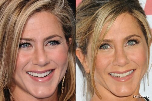 Jennifer Aniston a-t-elle succombé à la blépharoplastie ? Entre déni hollywoodien et analyse chirurgicale d'un regard iconique