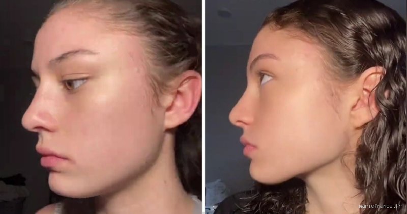 Mon visage sera-t-il plus beau si j'arrête de manger du sucre ? Enquête sur un sevrage cutané radical