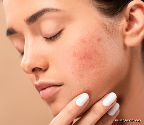 Quels sont les effets du sucre sur le visage et comment notre alimentation dicte la jeunesse de notre peau