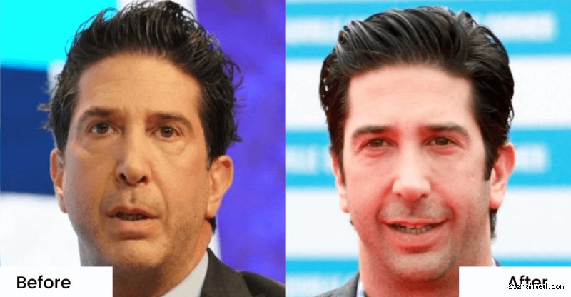 What has happened to David Schwimmer's face? Enquête sur la métamorphose de l'éternel Ross Geller