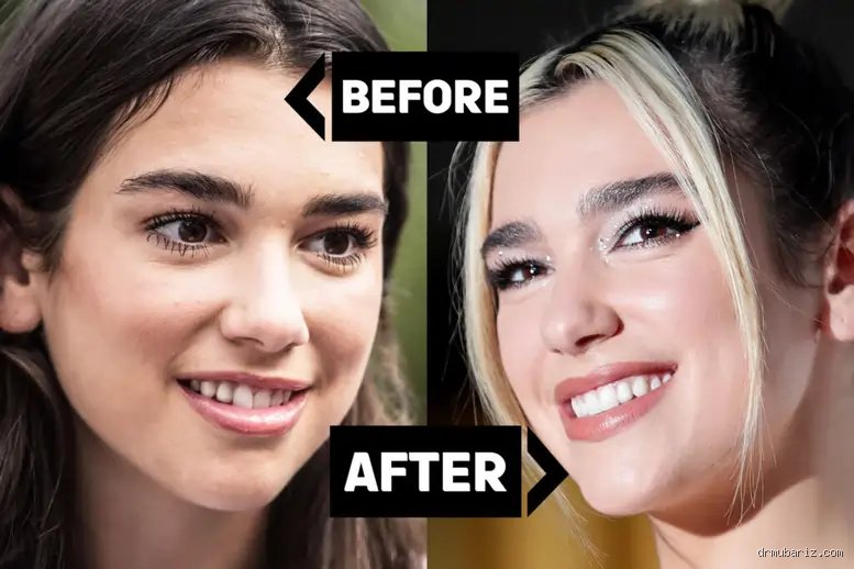 Dua Lipa et la chirurgie esthétique : réalité médicale ou simple évolution naturelle ?