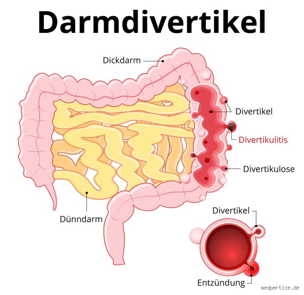 Können Divertikel wieder verschwinden?