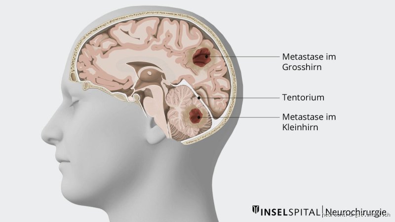 Hirnmetastasen: Todesurteil oder Hoffnungsschimmer? Was wirklich zählt!
