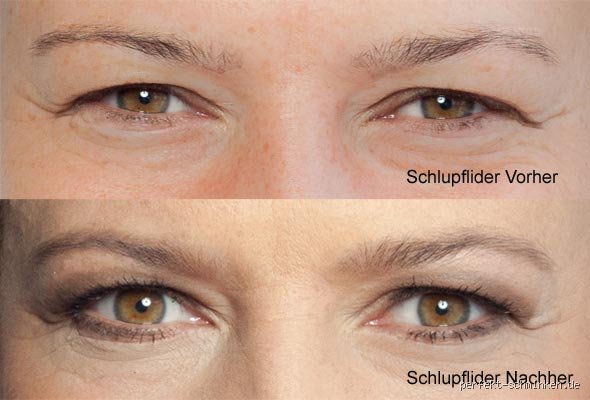 Werden Schlupflider wirklich vererbt? Die Wahrheit über unsere angeborene Augenform