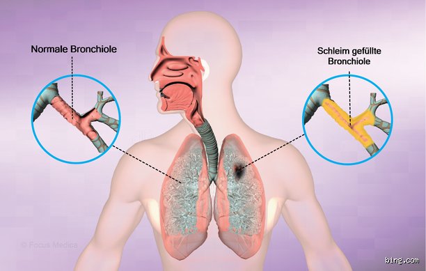 Wie lange kann eine hartnäckige Bronchitis dauern?
