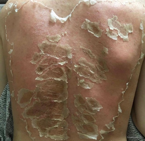 Algues marines et épiderme : que se passe-t-il si des algues se déposent sur votre peau lors de vos baignades ?