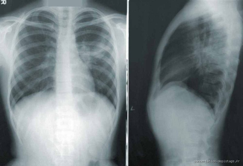 Est-il possible de vivre 10 ans avec des métastases ? Ce que la science et les nouveaux traitements changent aujourd'hui
