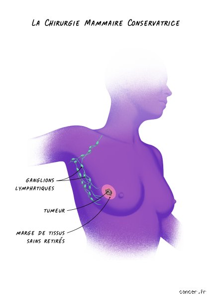 Qu'est-ce qui peut faire rétrécir une tumeur ? Décryptage des mécanismes qui forcent le cancer à reculer