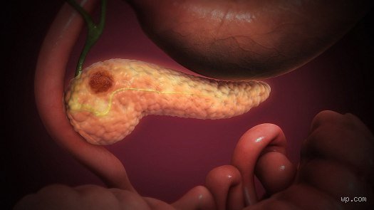 Quels sont les cancers qui ne présentent aucun symptôme ? La vérité sur les tueurs silencieux et l'impasse du diagnostic précoce