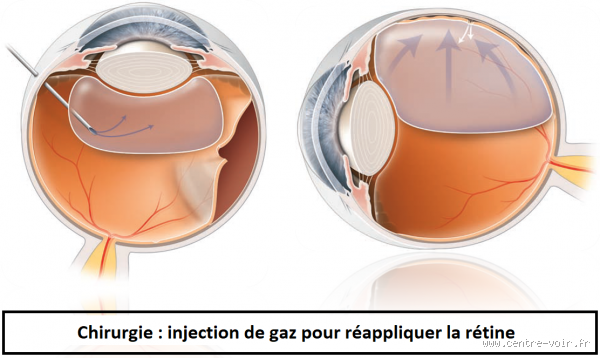 Comment se passe une opération du décollement de la rétine ? Explications détaillées