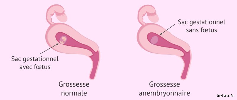 Quand apparaît l'embryon dans le sac gestationnel ?