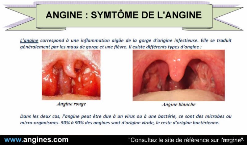 Où attrape-t-on une angine ? Toutes les réponses pour comprendre et se protéger