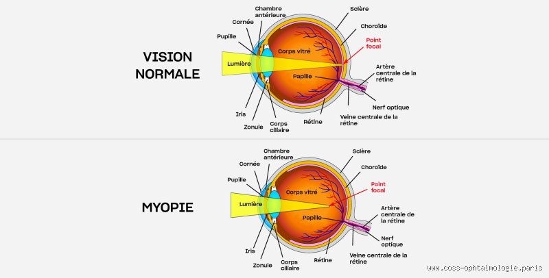 Myopie : Mais Qu'est-ce Qui Nous Fait Plisser les Yeux à Ce Point ?!