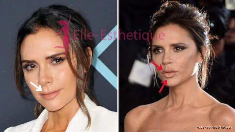 Victoria Beckham et la chirurgie esthétique : Décryptage de son évolution physique