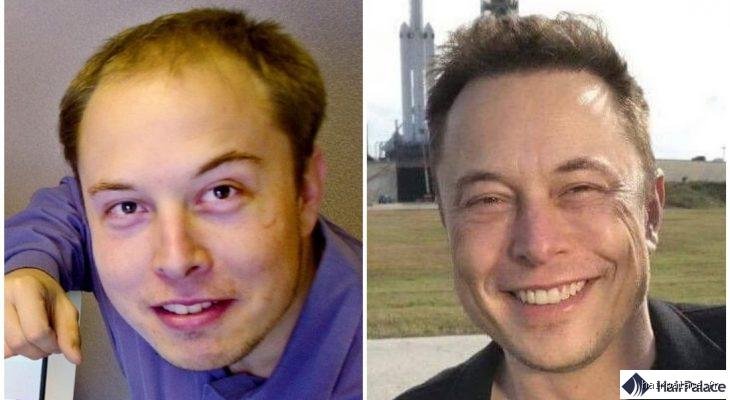 Quelles opérations chirurgicales Elon Musk a-t-il subies ? Enquête sur la métamorphose physique du milliardaire de la tech