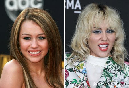 Why does Miley Cyrus wear dentures ? Derrière le sourire ultra-blanc, la vérité sur les facettes et prothèses de la star