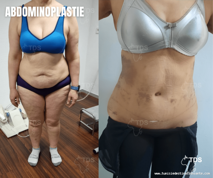 Quand Peut-on s'asseoir après une abdominoplastie ? Conseils et temps de récupération