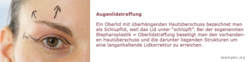 Wie werden Augenlider gestrafft? Meine ehrliche Einschätzung der Methoden