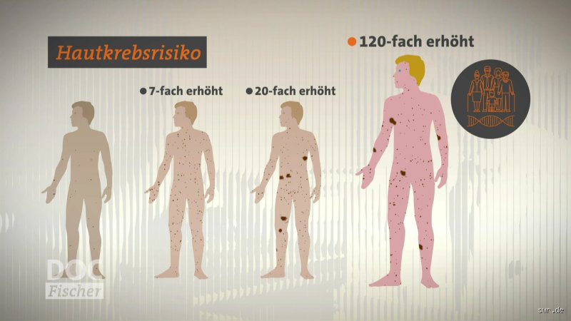 Für welche Menschen ist das Hautkrebsrisiko besonders hoch? Die kritischen Faktoren, die Sie kennen müssen