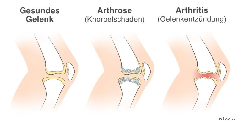 Hat man bei Arthrose erhöhte Entzündungswerte?