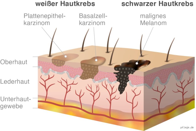 Hat man bei Hautkrebs Kopfschmerzen?