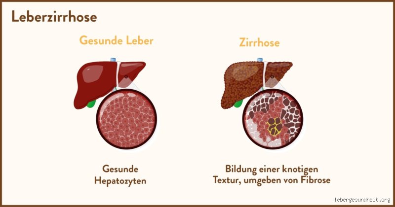 Hat man bei Leberzirrhose Gewichtsverlust?