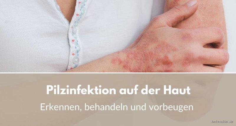 Ist chronischer Hautpilz heilbar?