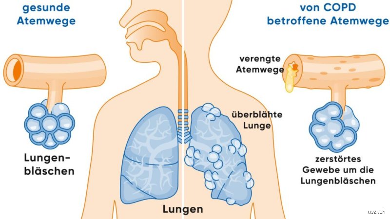 Ist COPD eine schlimme Krankheit? Warum die chronisch obstruktive Lungenerkrankung unterschätzt wird