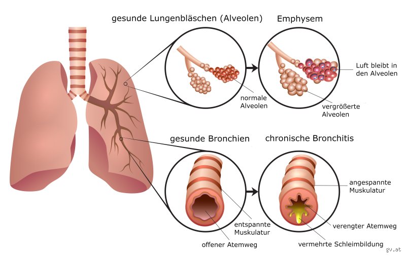 Ist die Krankheit COPD vererbbar?