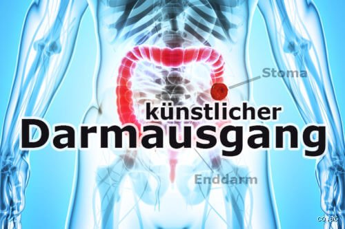 Ist ein künstlicher Darmausgang für immer?