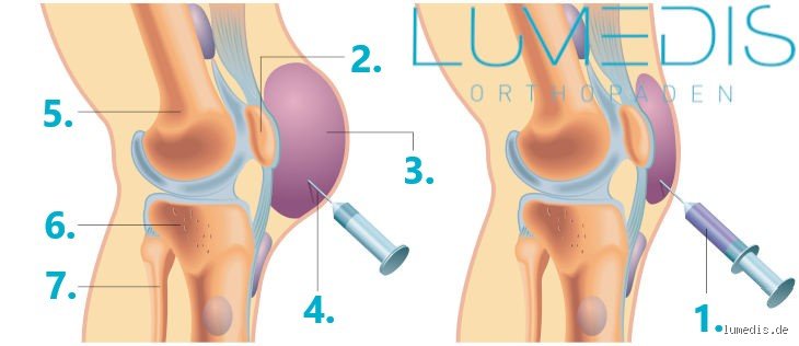 Ist eine Punktion am Knie schmerzhaft? Mein Blickwinkel auf das wahre Schmerzempfinden