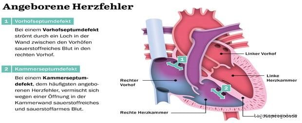 Ein Loch im Herzen beim Baby: Ist das wirklich schlimm und was bedeutet es für mein Kind?