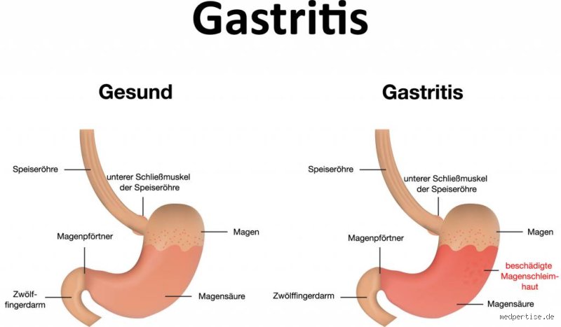 Die große Frage: Ist Wärme bei Gastritis wirklich wohltuend oder nur eine Illusion?