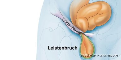 Kann ein Leistenbruch auf den Darm drücken?