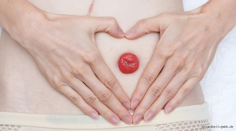 Stoma Rückverlegung: Gibt es ein Zurück zum "Normalzustand"?