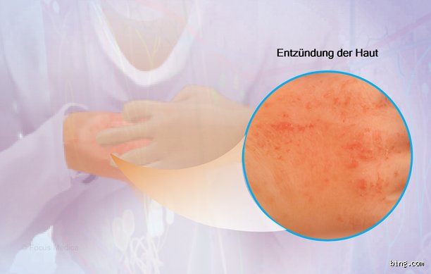 Kann Ekzem durch Stress verursacht werden?