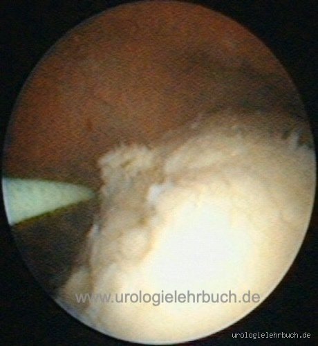 Kann man Candida im Urin feststellen? Wie die Labordiagnostik Pilzinfektionen der Harnwege wirklich aufdeckt