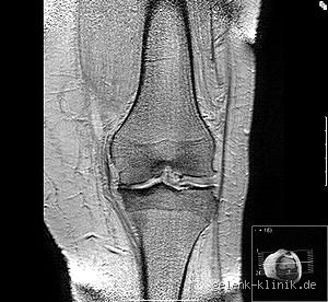 Kann man eine Arthrose im MRT wirklich sehen? – Ein Einblick in die Diagnose
