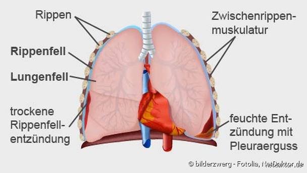 Muss die Rippenfellentzündung wehtun? Die ehrliche Antwort auf die Frage, ob man die Pleuritis spürt