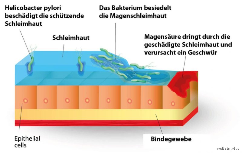 Kann man Helicobacter zweimal haben?